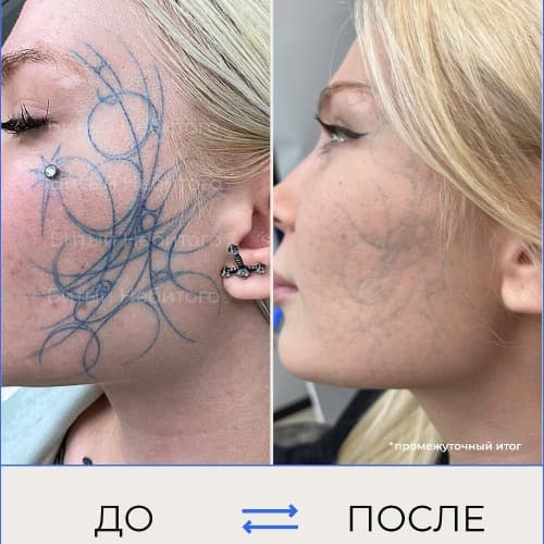 Удаление татуировки